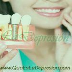 ¿Implantes dentales? Lo que debes saber 5 Implantes dentales - lo que debes saber